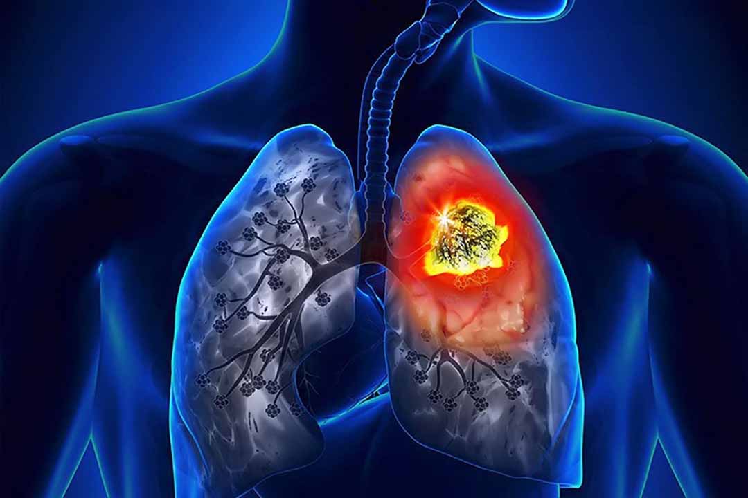 Phế ung  là trạng thái phổi có mủ